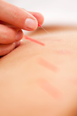 Qi - Acupuncture Neddle Rotation and Stimulation