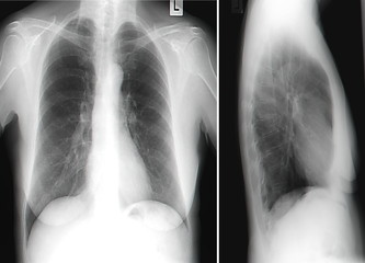 Radiograph of chest
