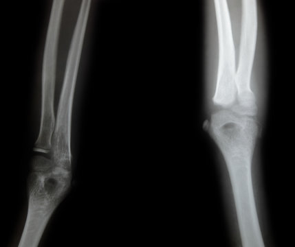 x-ray of a young people arm