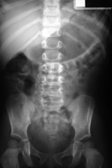 R&ouml;ntgenaufnahme Brustkorb und Beckenknochen