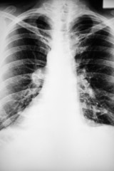 Fototapeta na wymiar Röntgenaufnahjme płuca