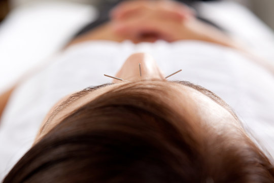 Acupuncture Facial Treatment Detail