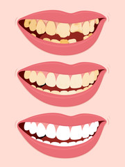 Progressive Stages Of Tooth Decay caries