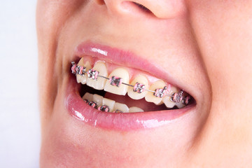 teeth with braces
