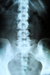 X-ray of the pelvis and spinal column.