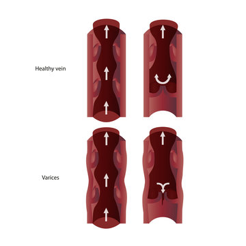 Varices eps10 vector illustration