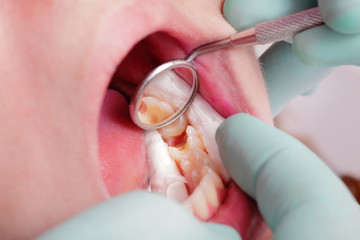 Dental, tooth cavity in closeup