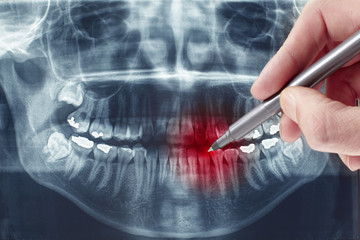 Dental xray