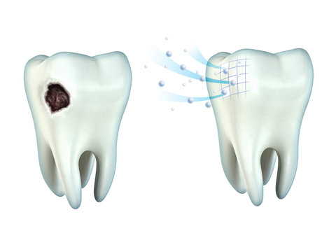 Teeth cavity