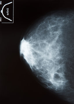 Mammography