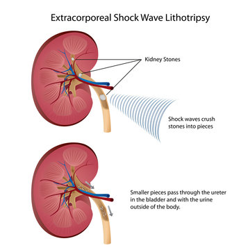 kidney ultra shock lithotripsy vector illustration