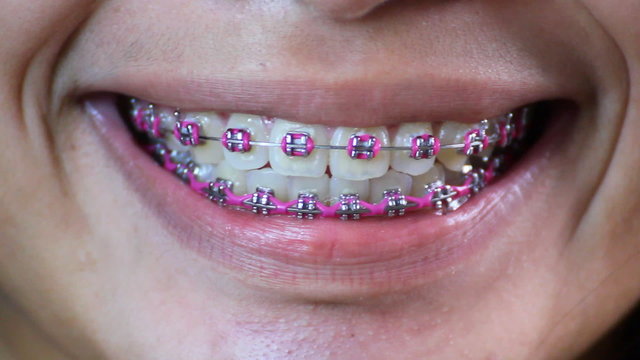 Lady with dental braces