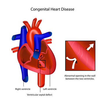 congenital heart disease medical vector illustration