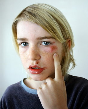 visage d'enfant contusionn&eacute;