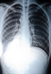 x-ray of chest