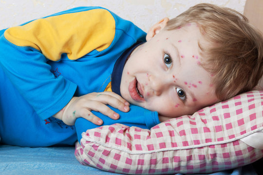 Boy suffers chickenpox