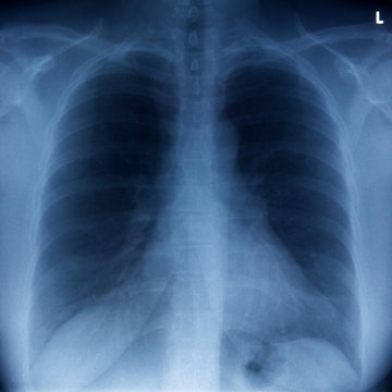 Röntgenbild Brustkorb