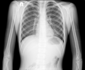 X-ray of human chest