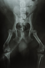 X-ray