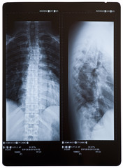 Back X-ray showing scoliosis (curvature). 2 views. Female.