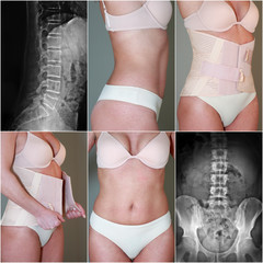 corsetto ortopedico lombare con raggi x - obrazy, fototapety, plakaty