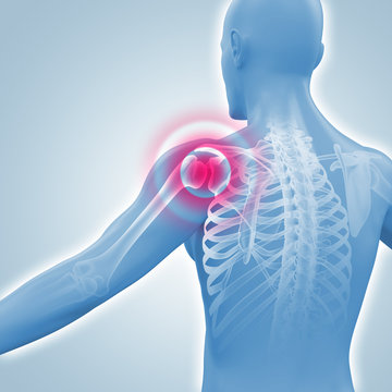 Schmerzen in der Schulter - Röntgenbild