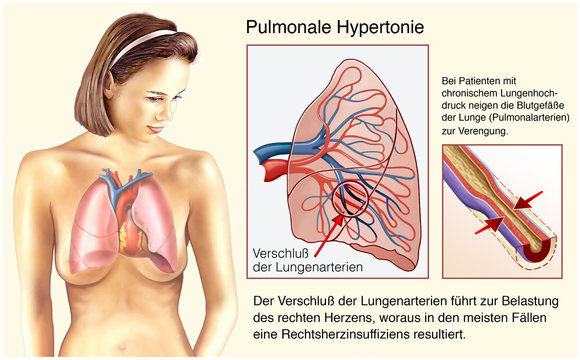 Pulmonale Hypertonie.Lungenhochdruck