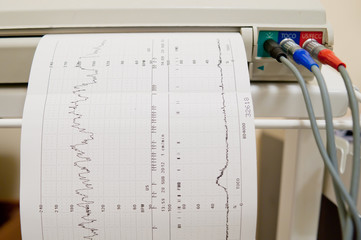 Cardiogram test Ekg heart pulse results on the graph paper