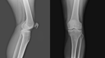 X-ray of both human knee