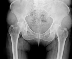 X-ray of the pelvis