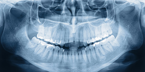 X-ray scan of teeth - obrazy, fototapety, plakaty