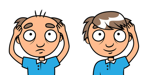 Bald man - hair loss treatment