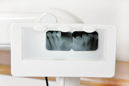 tooth x-ray