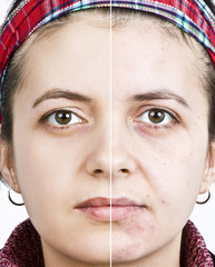 Woman with spotty skin with deep pores