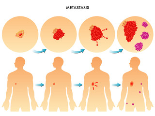 metastasi - obrazy, fototapety, plakaty