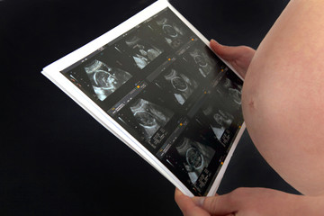 A pregnant woman looking at her echography.