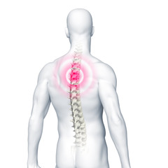 Rückenschmerzen - Rücken mit der Wirbelsäule