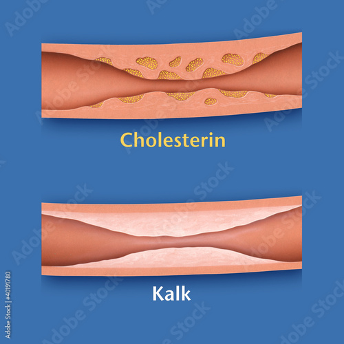 "Gefäßablagerungen" Stock photo and royalty-free images on Fotolia.com