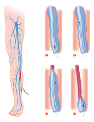 varicose_veins