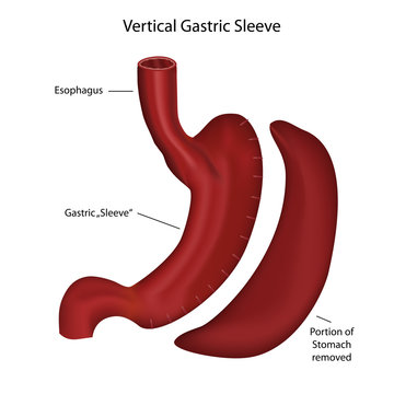 vertical gastric sleeve medical vector illustration