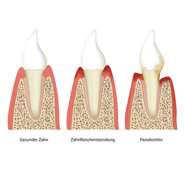 parodontitis tooth plaque vector illustration