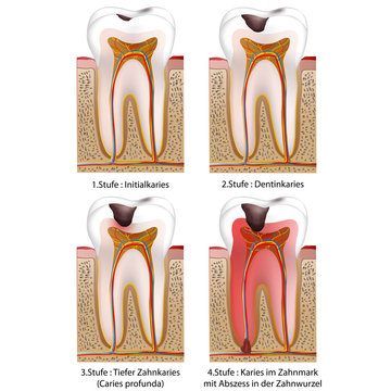 4 stufen des karies im zahn vektor illustration
