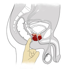  Illustration of Digital Rectal Examination (DRE) for Prostate Cancer Screening