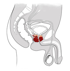 Illustration of prostate cancer cross-section showing cancerous prostate