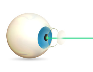 Laser Eye Surgery