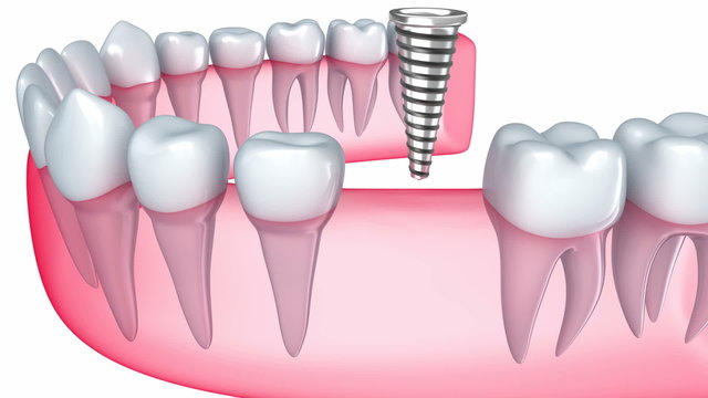 Implant is embedded in the gum
