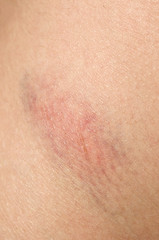 Fototapeta premium Injury on skin