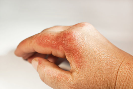 Verbrennungen an der Hand