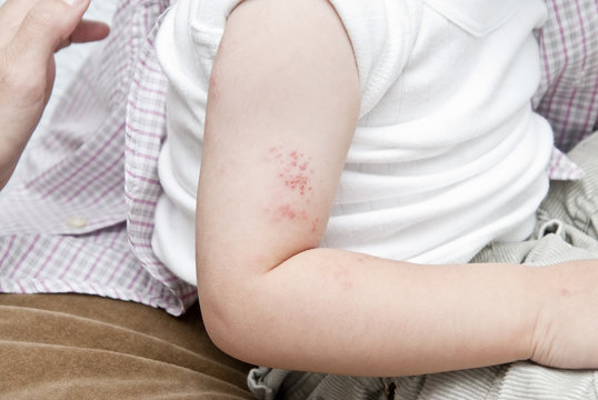 Herpes zoster con ampollas en el brazo.