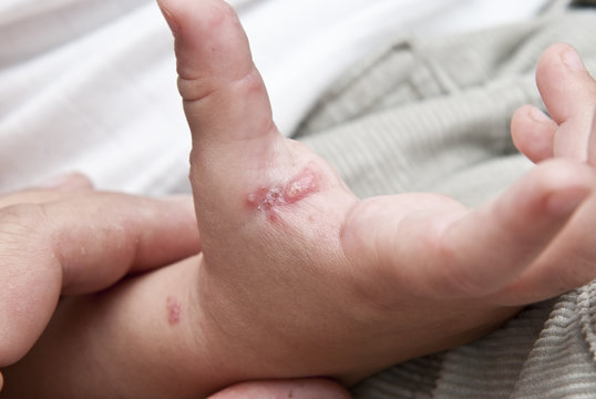 guión Empresa Estallar Ampollas del herpes zoster en la mano de un niño. foto de Stock | Adobe  Stock